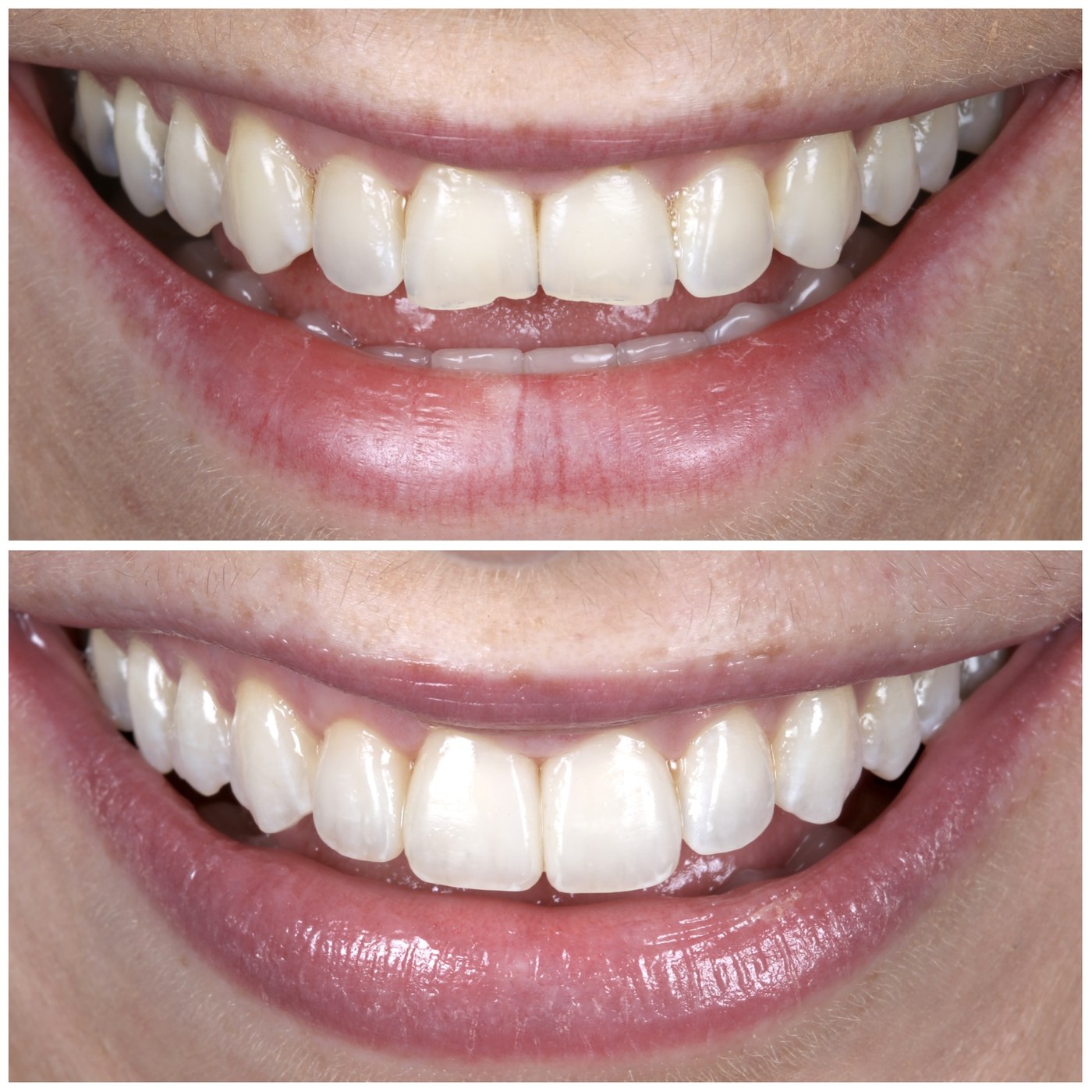 Composite bonding before and after in Dublin: chipped and worn upper front teeth rebuilt with hand-layered composite at Docklands Dental