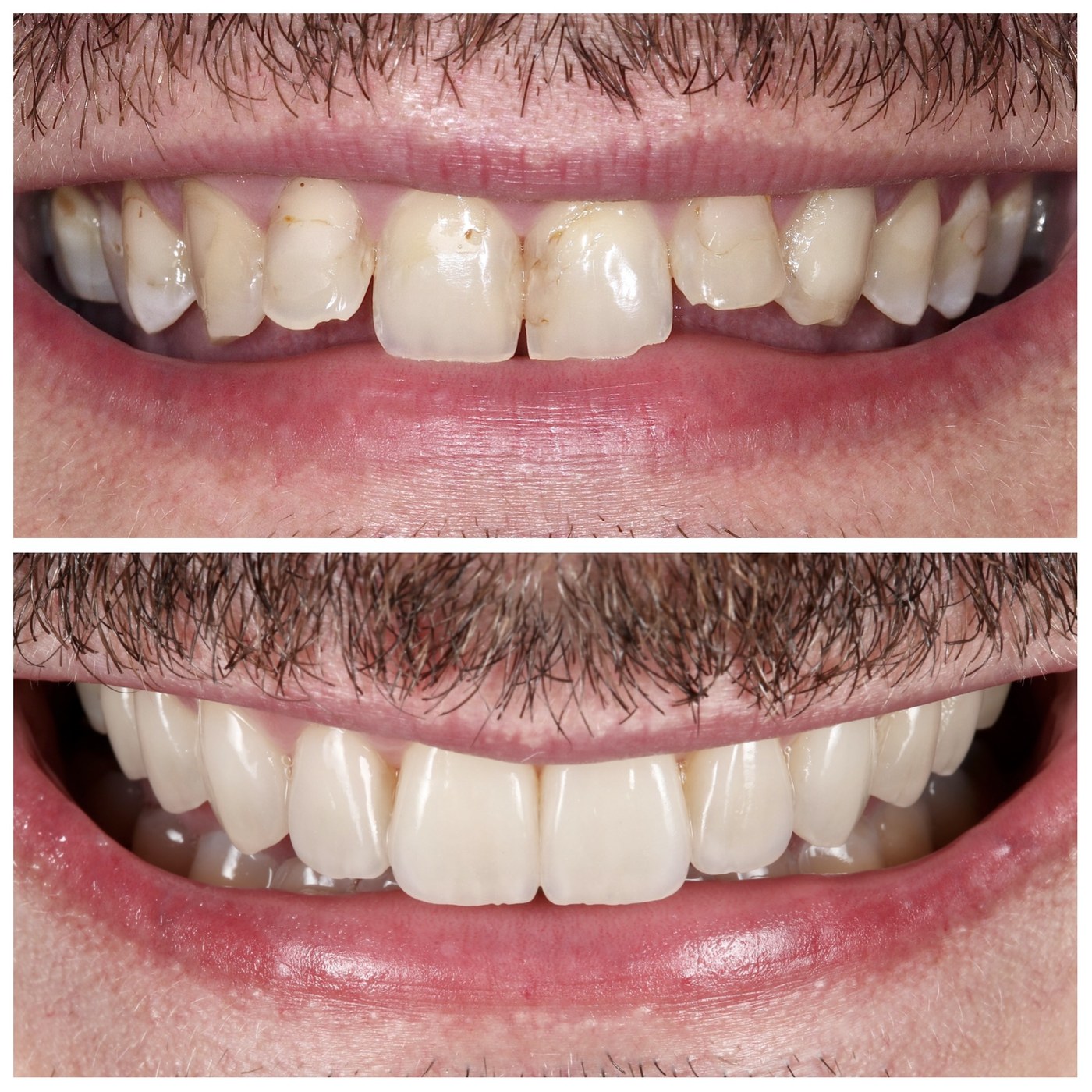Before and after a Dublin smile makeover: worn, chipped and discoloured upper teeth above, and the finished result after orthodontics and porcelain veneers below